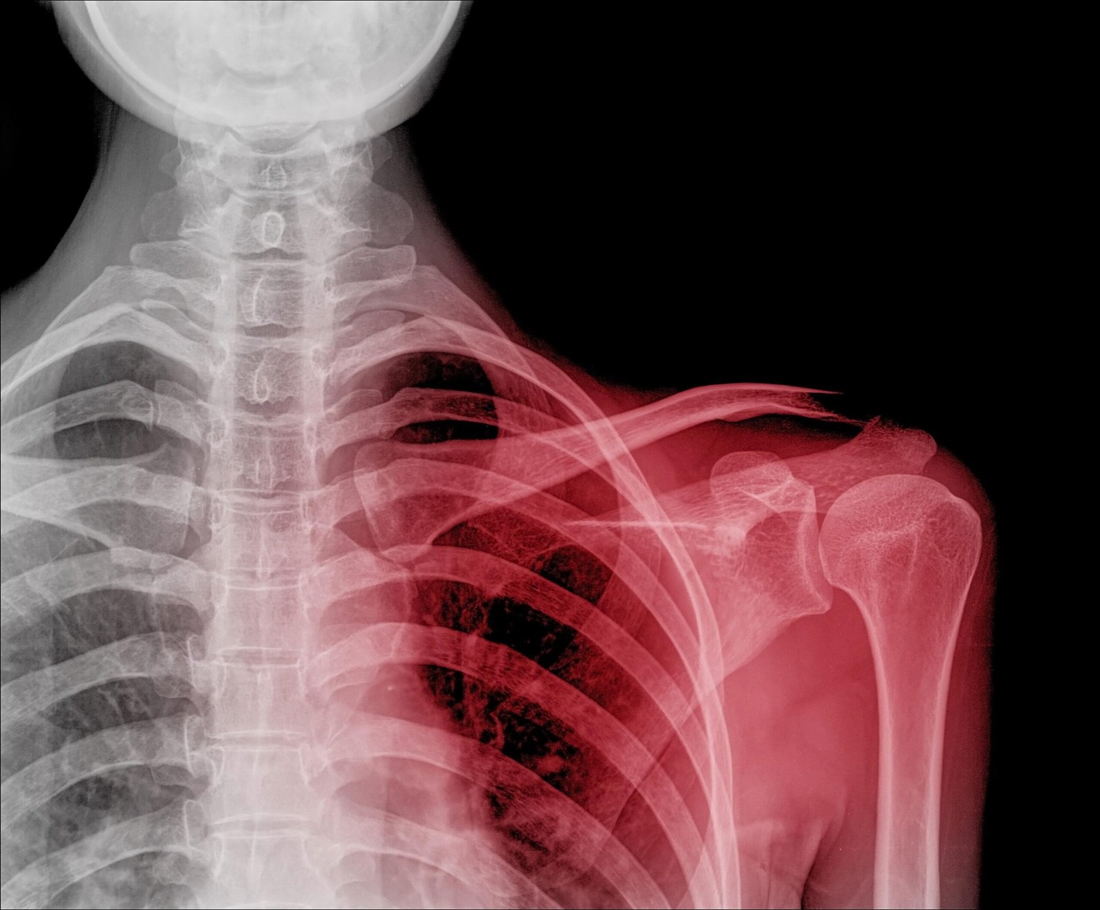 Medical Definition of Dislocation