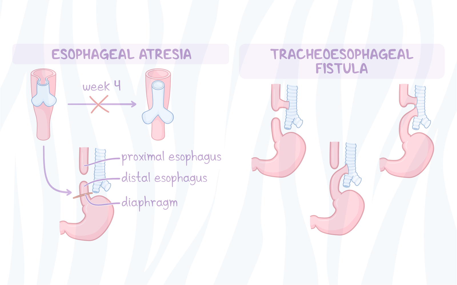 Esophageal Atresia/Trachea-Eosophageal Fistula | CHAPTER 8 | Pediatric Nursing