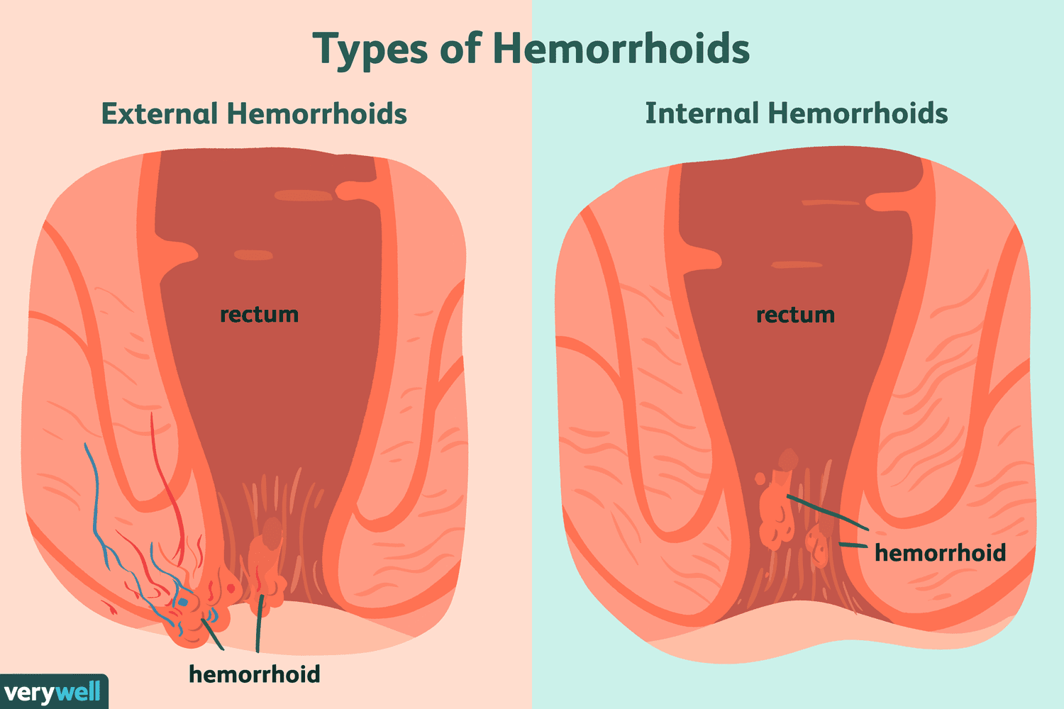 Hemorrhoids