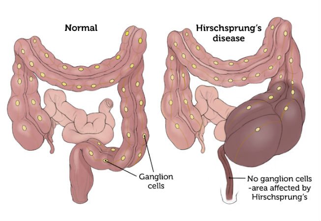 Hirschsprungs disease | CHAPTER 8 | Pediatric Nursing