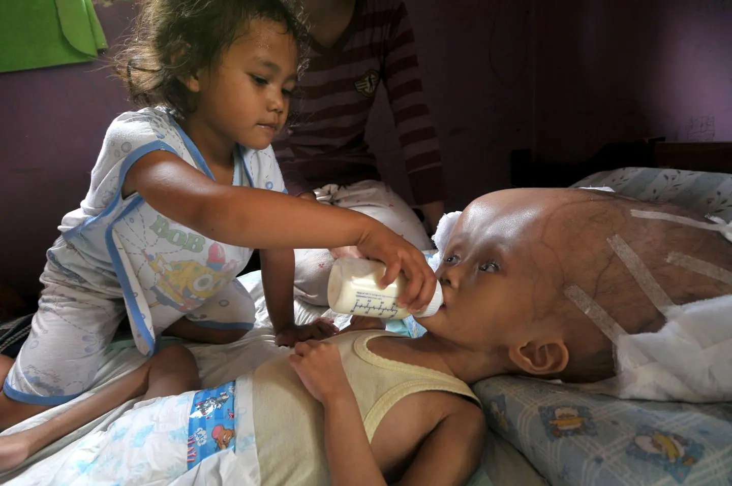 Concept about Hydrocephalus | CHAPTER 8 | Pediatric Nursing