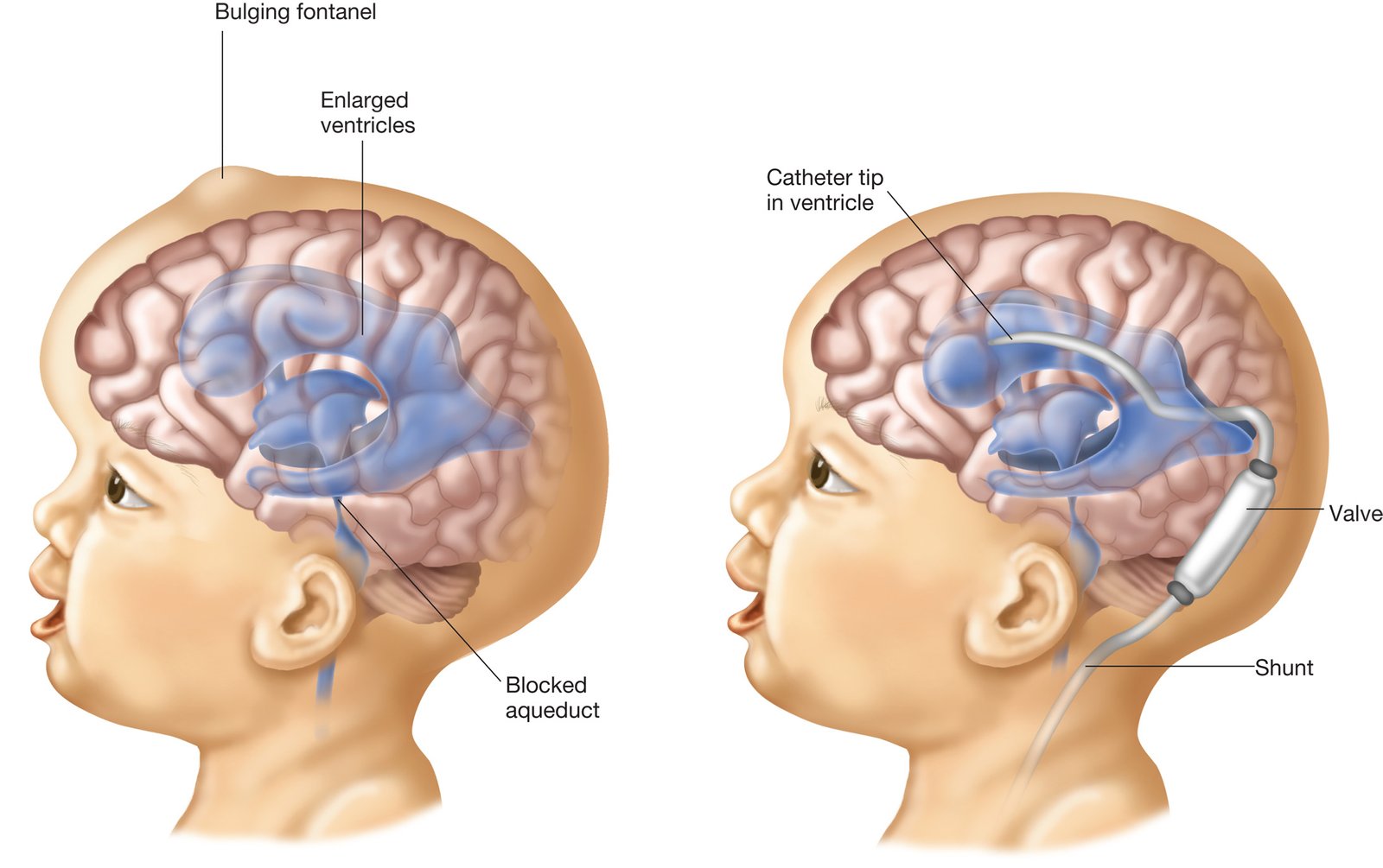 Concept about Hydrocephalus | CHAPTER 8 | Pediatric Nursing