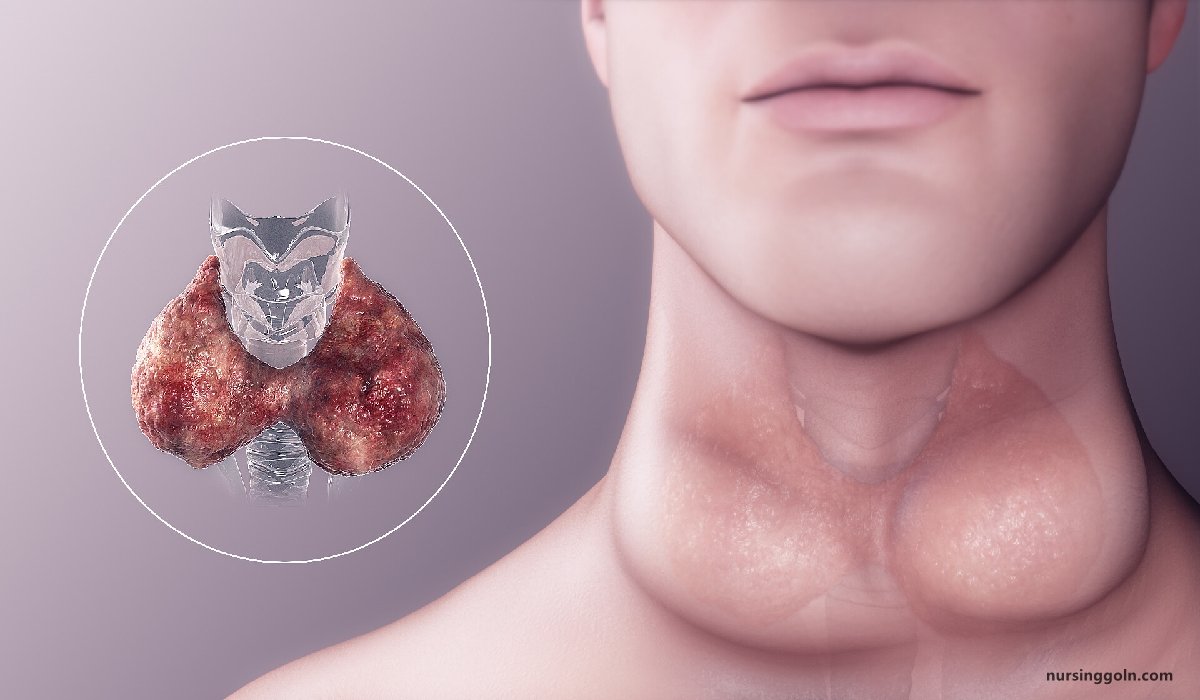 Concept of Hypothyroidism | CHAPTER-15 | Medical and Surgical Nursing