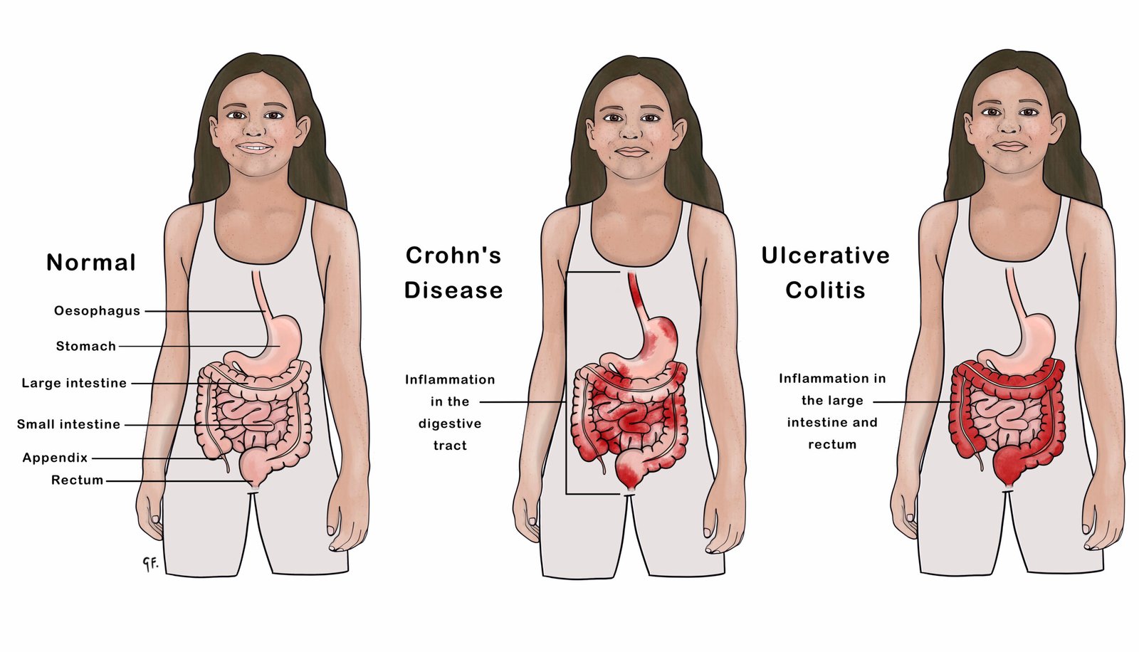 Inflammatory bowel disease