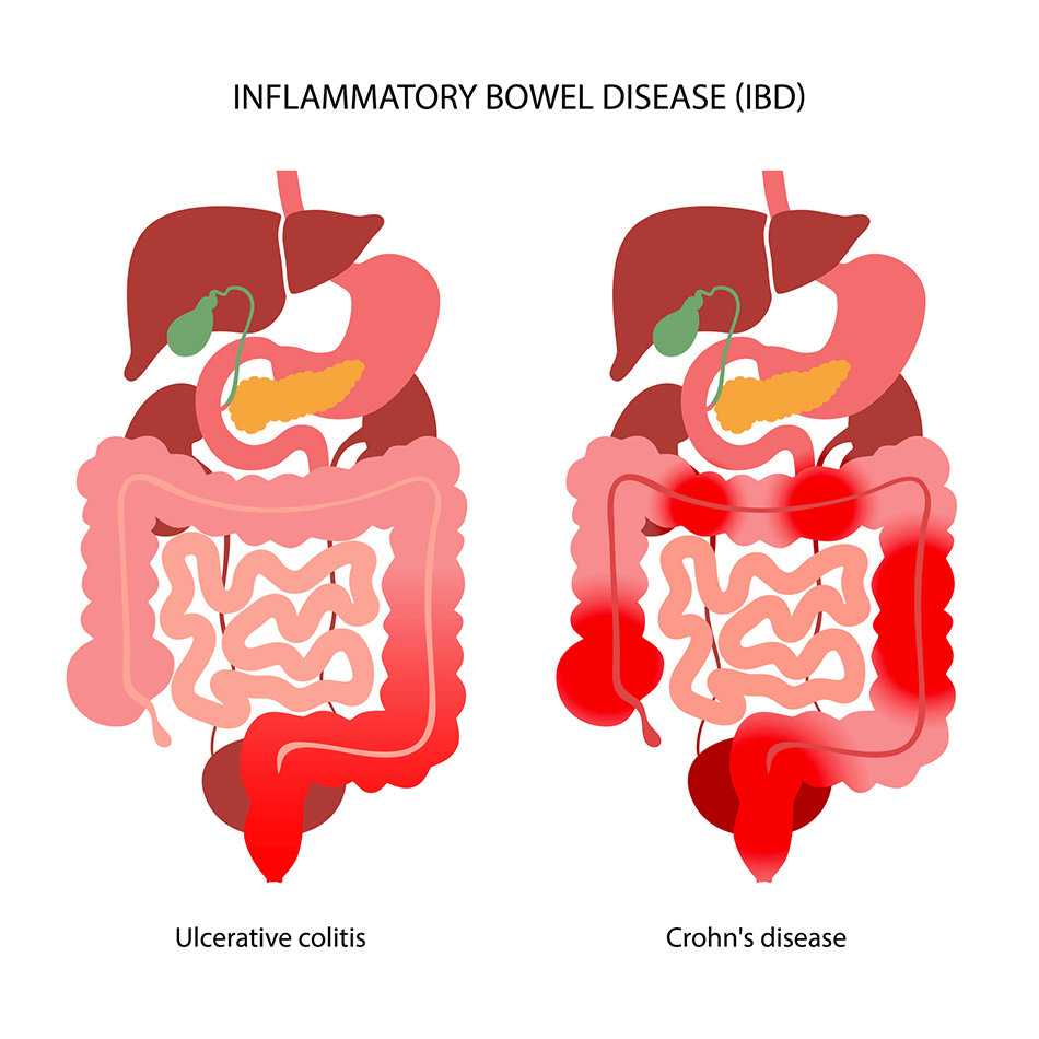 Inflammatory bowel disease