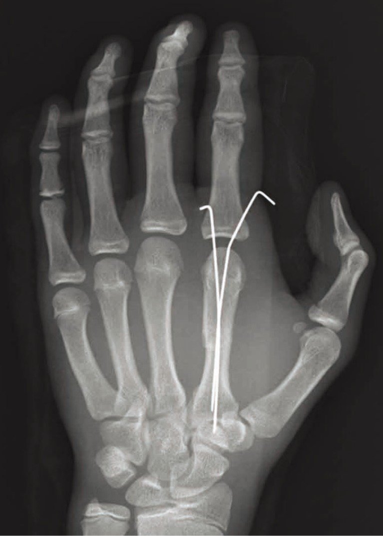 Definition of K-wire