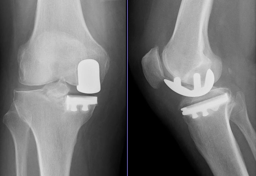 Knee Arthroplasty | CHAPTER 11 | Orthopedic Nursing