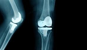 Knee Arthroplasty | CHAPTER 11 | Orthopedic Nursing
