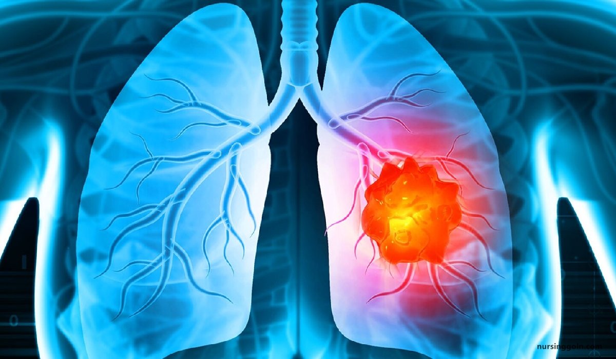 Lung cancer | CHAPTER-12 | Medical and Surgical Nursing