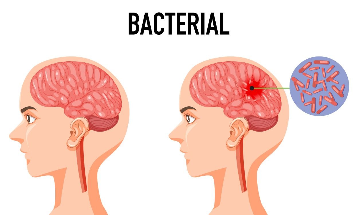 Definition of Meningitis | CHAPTER 6 | Pediatric Nursing