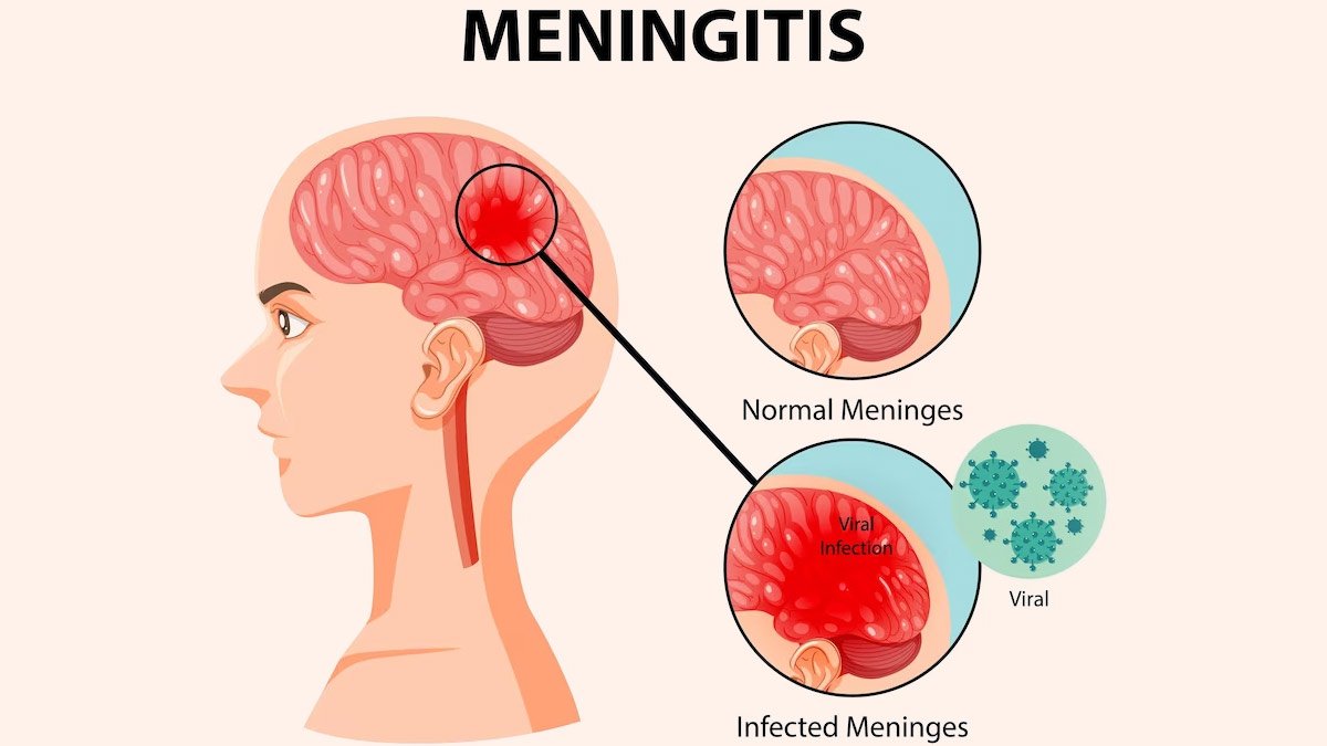 Definition of Meningitis | CHAPTER 6 | Pediatric Nursing