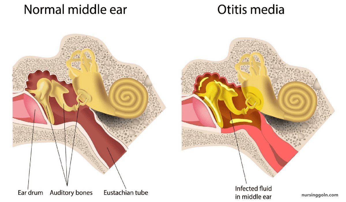 Otitis Media | CHAPTER-10 | Medical and Surgical Nursing