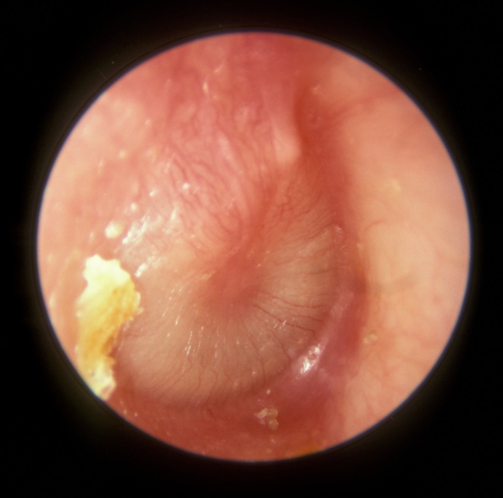 Otitis media | CHAPTER 6 | Pediatric Nursing