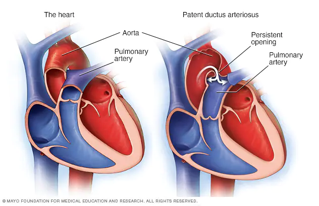 Patent ductus arteriosus (PDA)