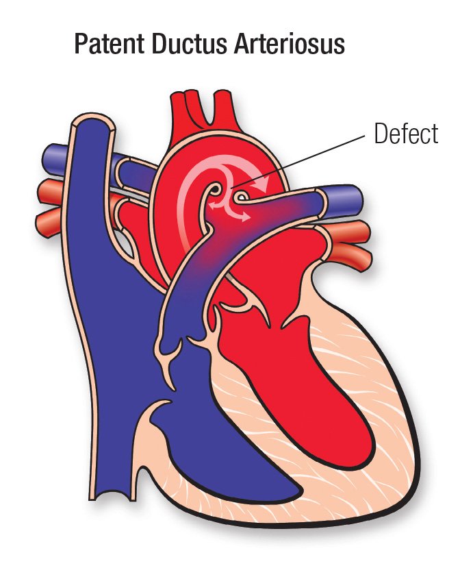 Patent ductus arteriosus (PDA)