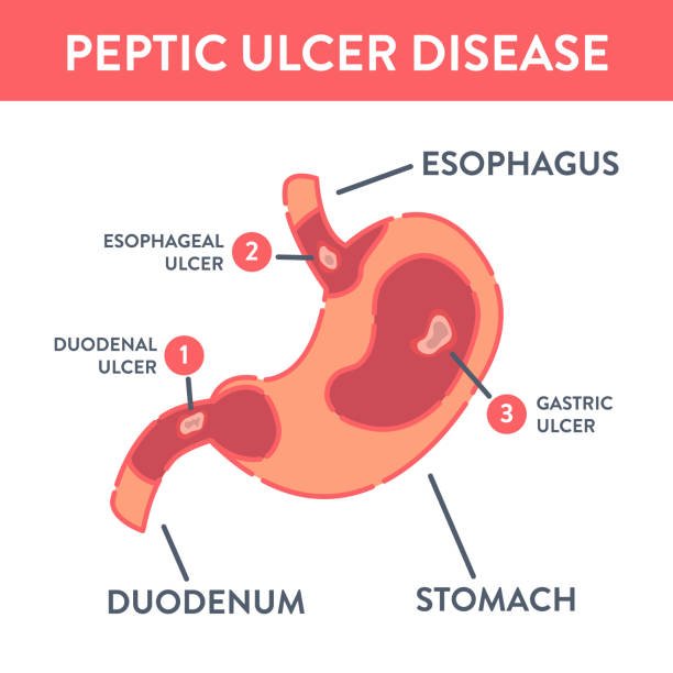 Medical Peptic Ulcer Disease | CHAPTER-6 | Medical and Surgical Nursing