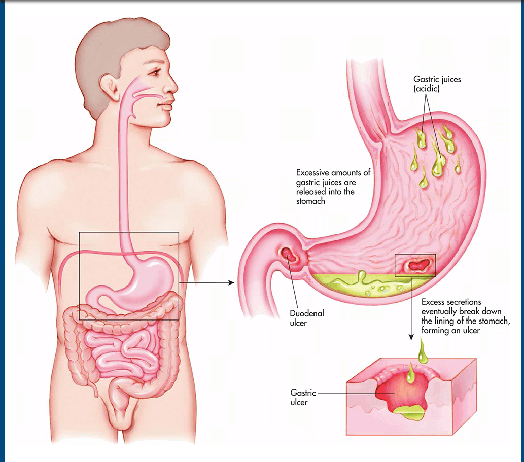Medical Peptic Ulcer Disease | CHAPTER-6 | Medical and Surgical Nursing