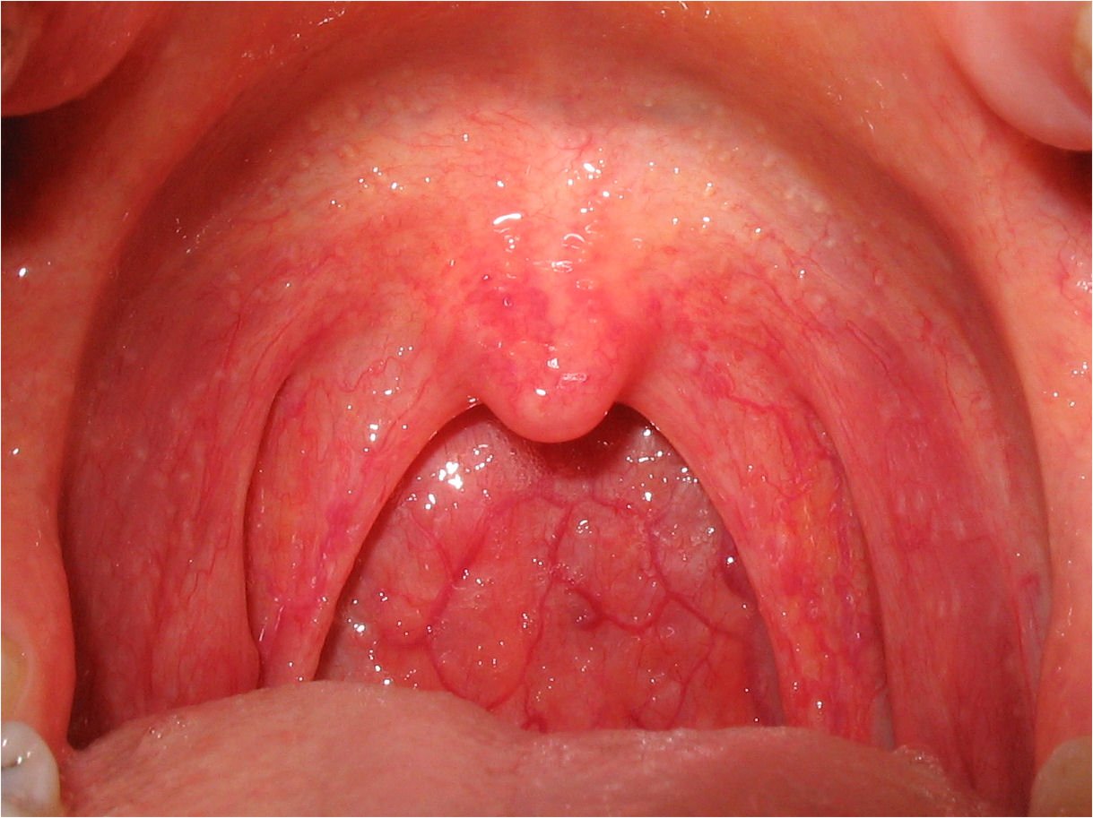 Definition of Pharyngitis | CHAPTER 6 | Pediatric Nursing