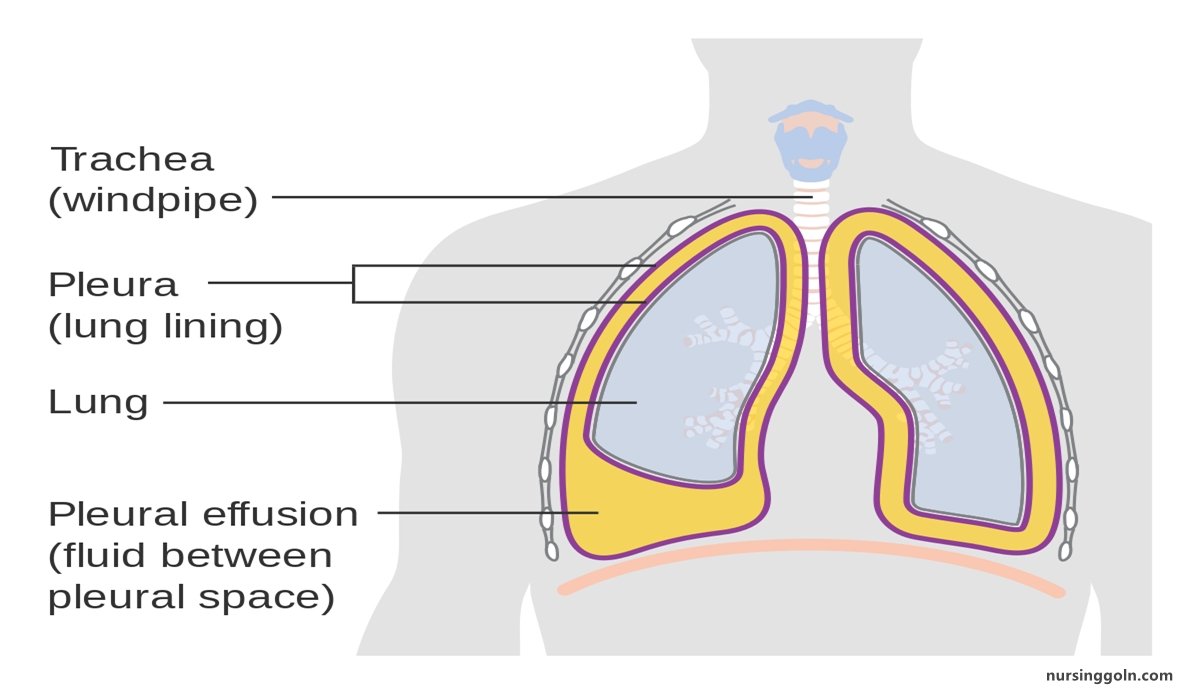 Pleural Effusion | CHAPTER-8 | Medical and Surgical Nursing