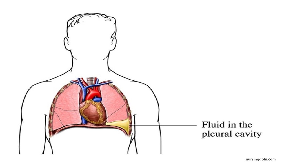 Pleural Effusion | CHAPTER-8 | Medical and Surgical Nursing