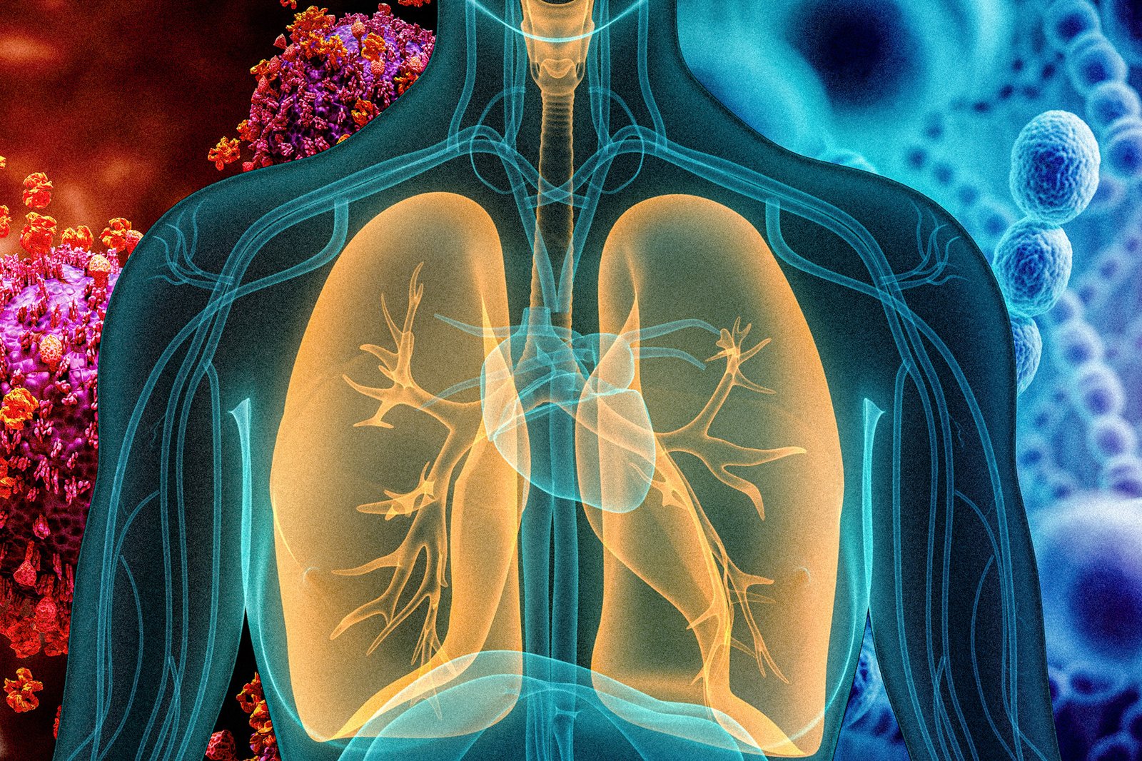 Concepts of Pneumonia | CHAPTER 6 | Pediatric Nursing