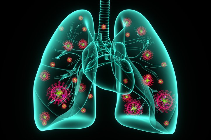 Concepts of Pneumonia | CHAPTER 6 | Pediatric Nursing