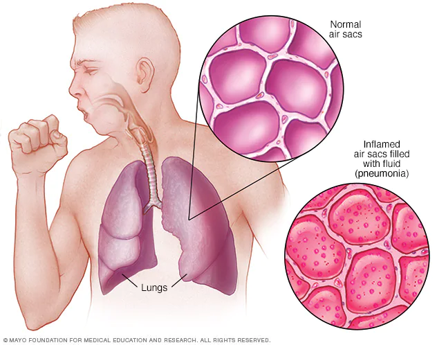 Concepts of Pneumonia | CHAPTER 6 | Pediatric Nursing