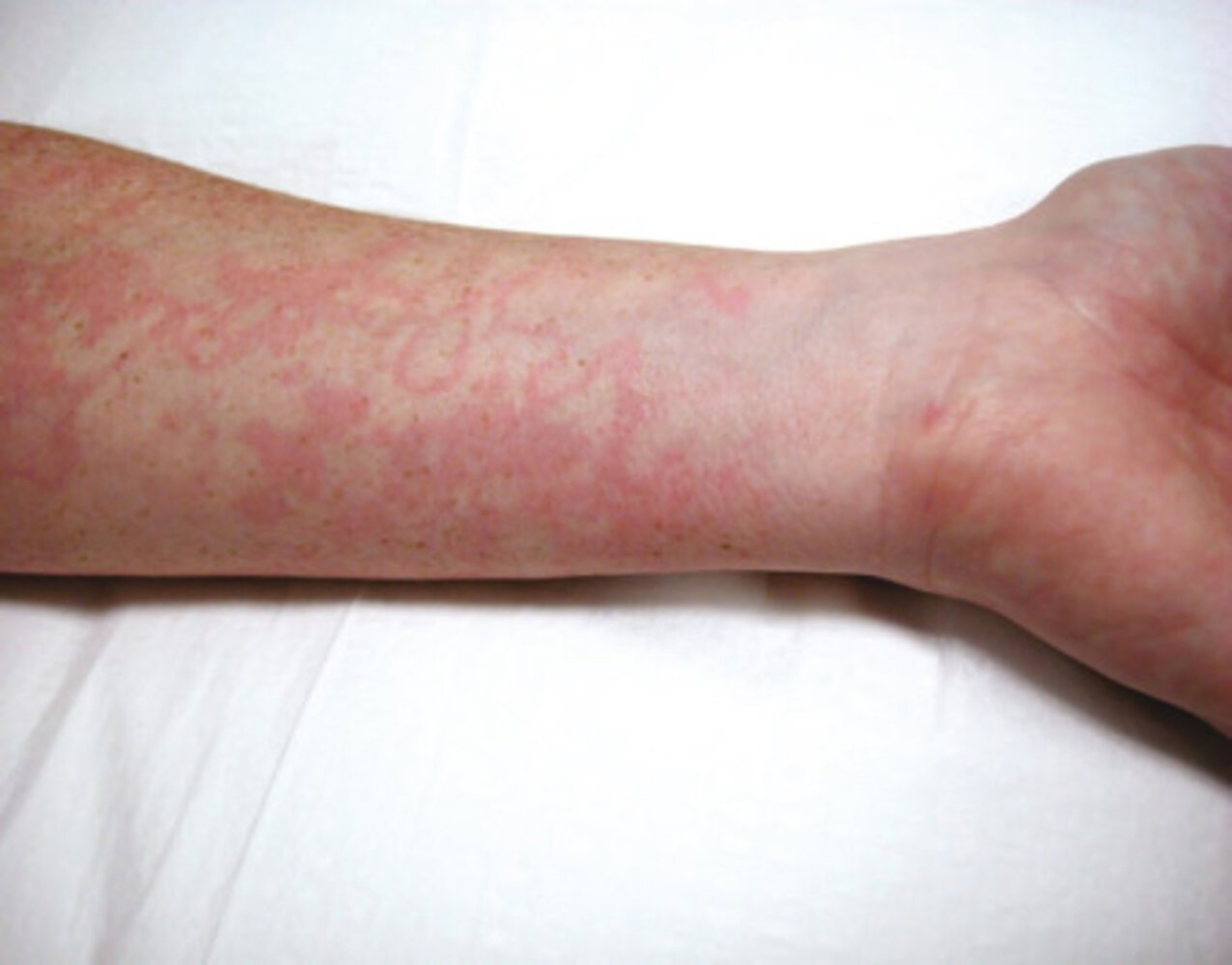 Medical Rheumatic Fever | CHAPTER 10 | Pediatric Nursing