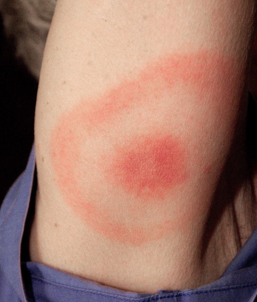 Rheumatic Fever | CHAPTER 10 | Pediatric Nursing