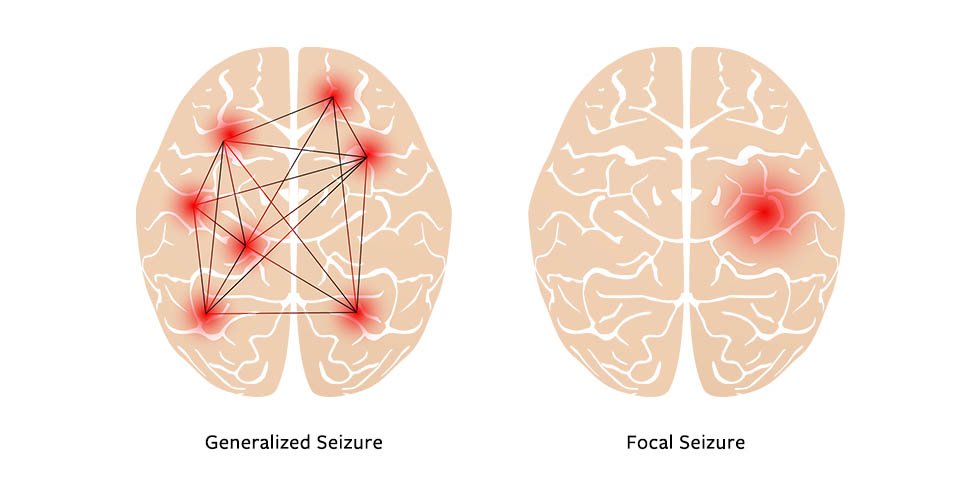 Concept about Seizure | CHAPTER 7 | Pediatric Nursing