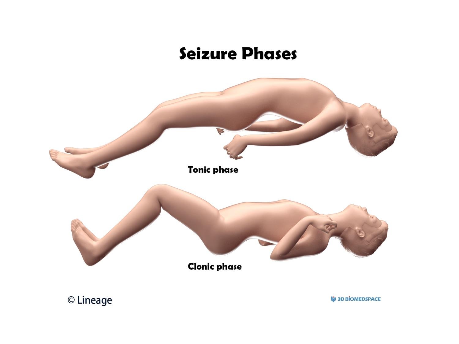 Concept about Seizure | CHAPTER 7 | Pediatric Nursing