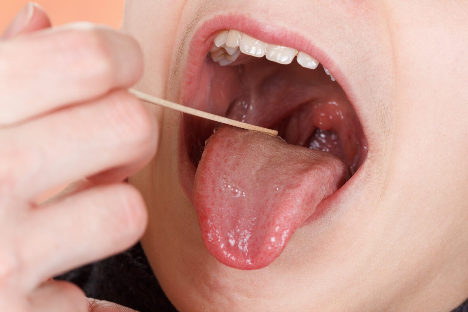 Definition of Tonsillitis | CHAPTER 6 | Pediatric Nursing