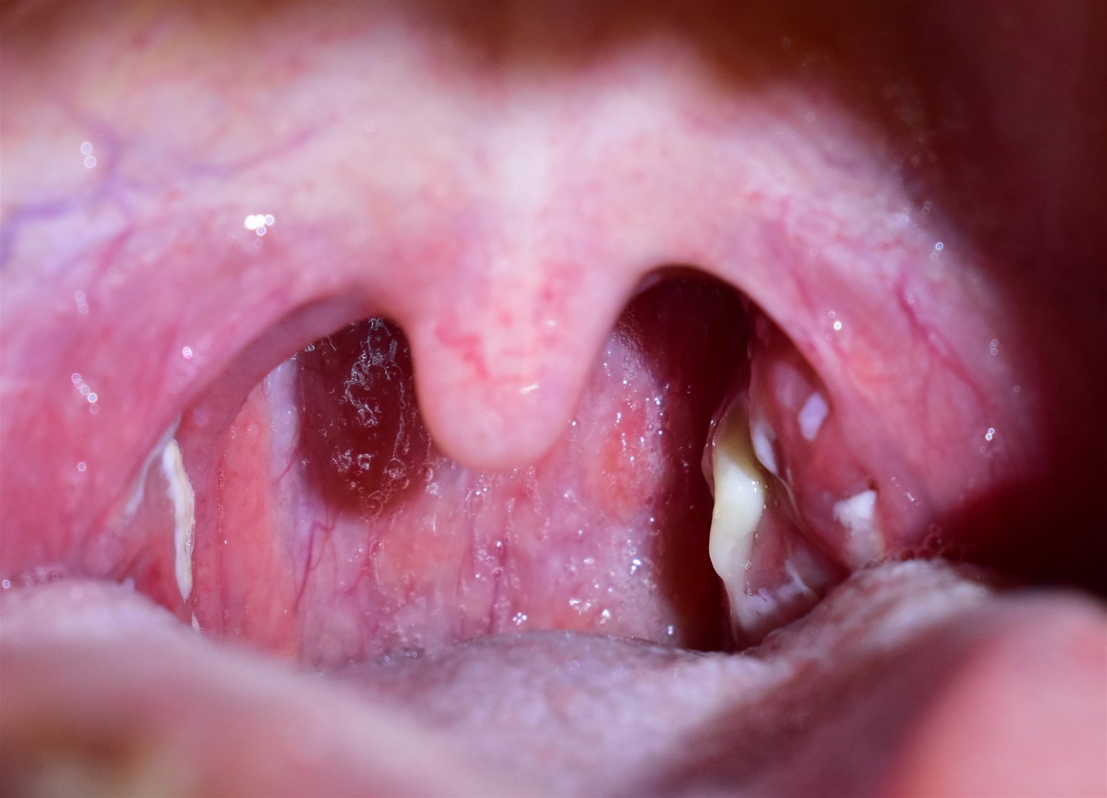 Definition of Tonsillitis | CHAPTER 6 | Pediatric Nursing