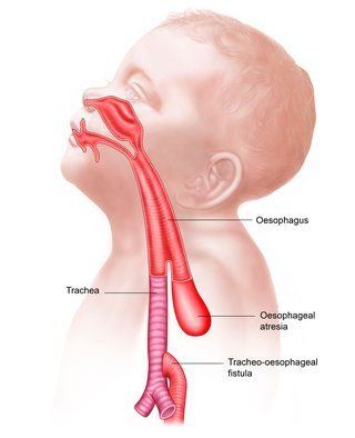 Esophageal Atresia/Trachea-Eosophageal Fistula | CHAPTER 8 | Pediatric Nursing