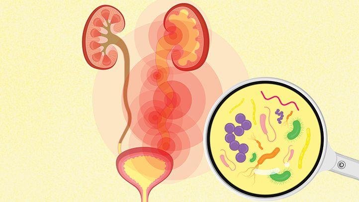 Urinary Tract Infection (UTI)