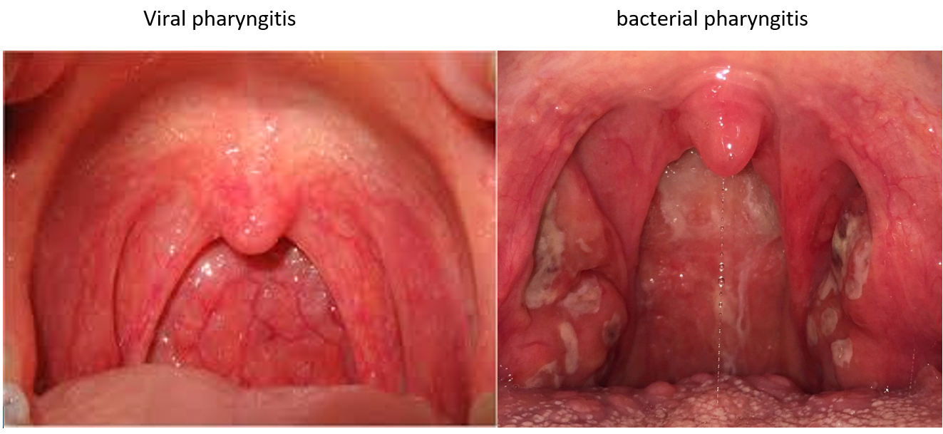 Definition of Pharyngitis | CHAPTER 6 | Pediatric Nursing