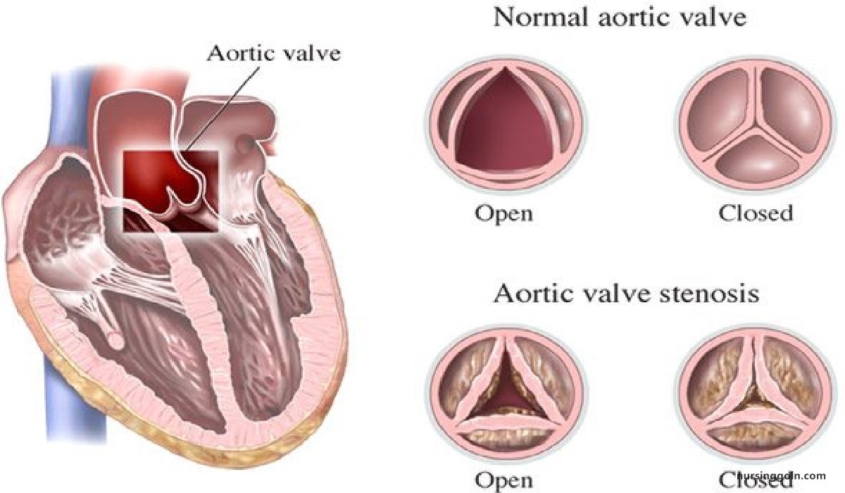 Vulvular Heart Disease /Problems | CHAPTER-13 | Medical and Surgical Nursing