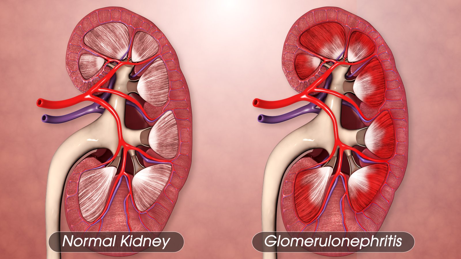 Acute Glomerulonephritis (AGN) | Chapter 7 | Medical And Surgical Nursing