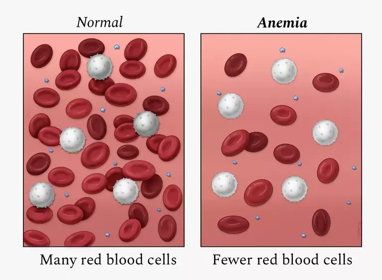 Concept of Anemia | CHAPTER-10 | Medical and Surgical Nursing