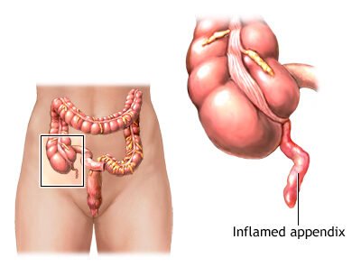 Appendicitis