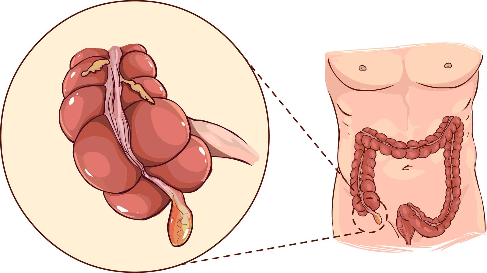 Acute appendicitis | CHAPTER-6 | Medical and Surgical Nursing