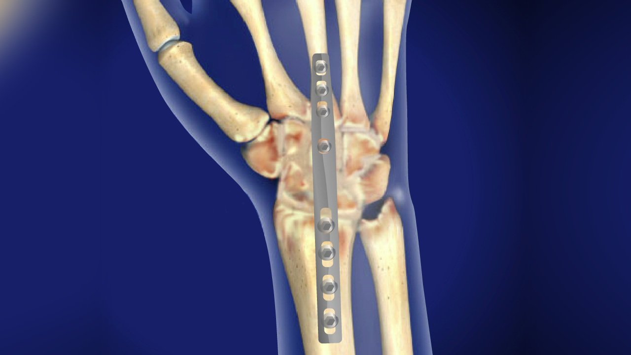 Arthrodesis of wrist joint | CHAPTER 10 | Orthopedic Nursing