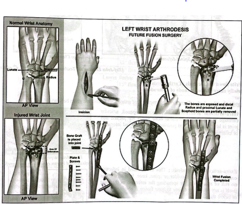 Definition of Arthrodesis | CHAPTER 10 | Orthopedic Nursing