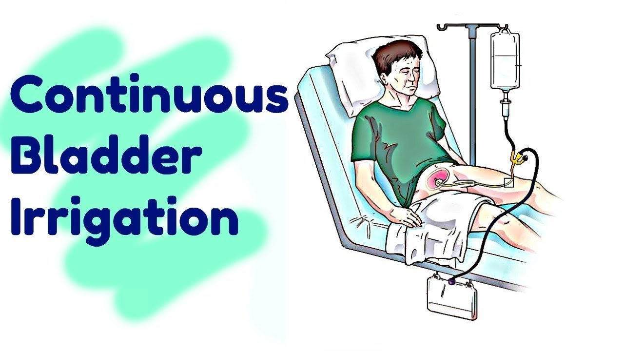 Concept about Bladder Irrigation