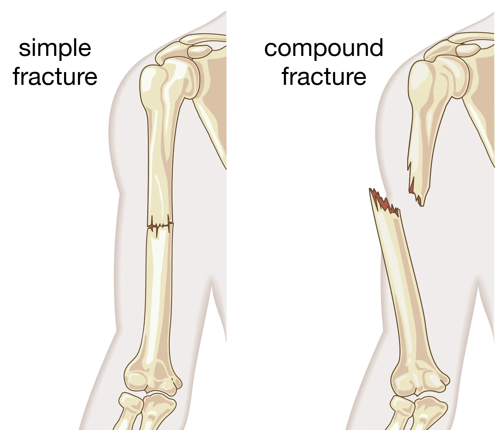 Definition of Fracture