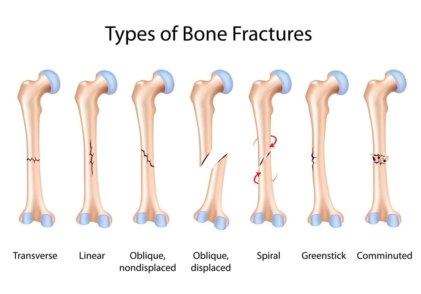 Definition of Fracture