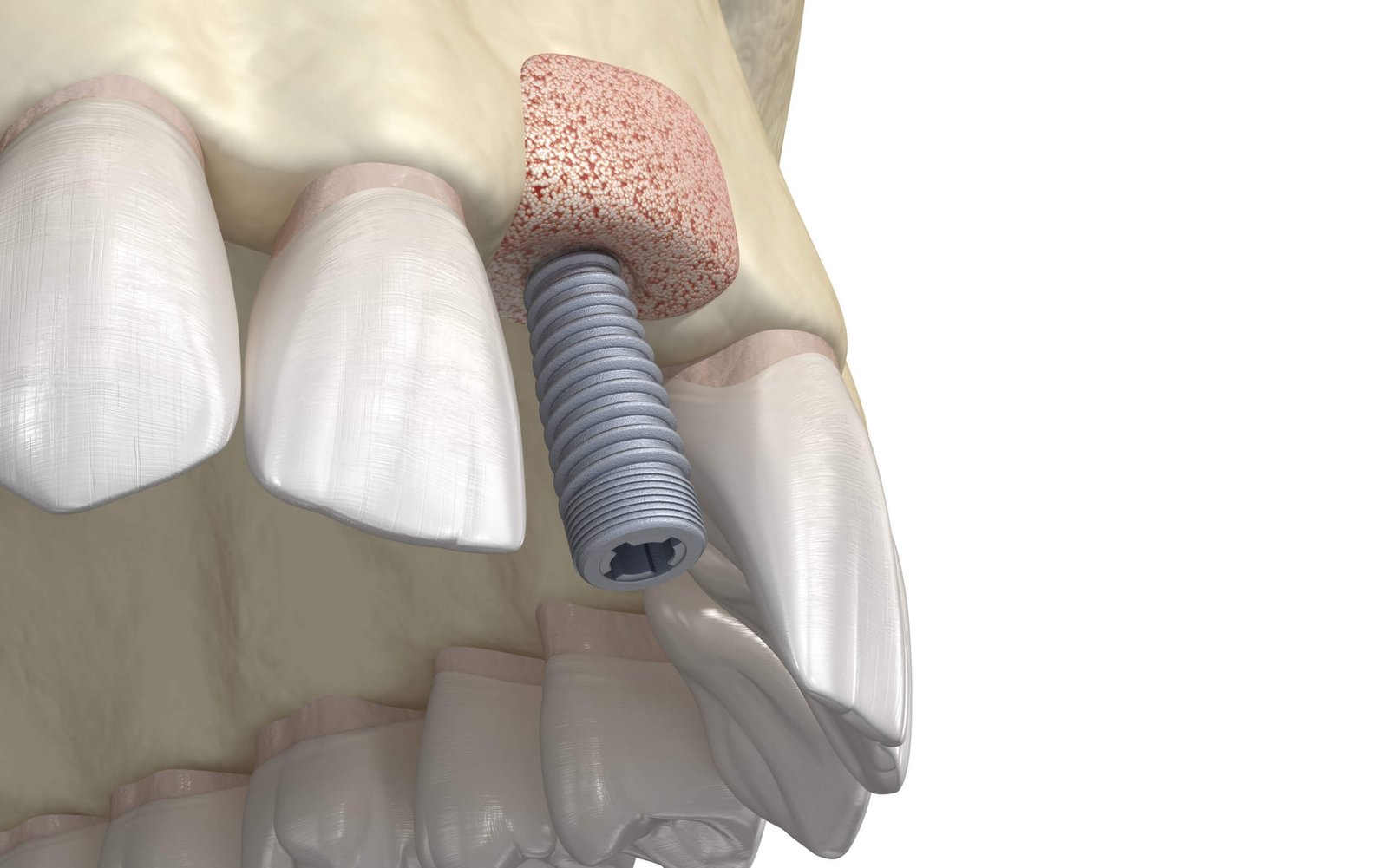 Medical Bone Grafting
