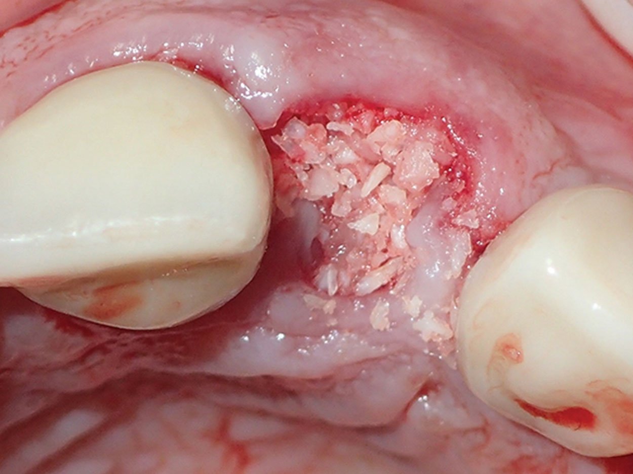 Medical Bone Grafting