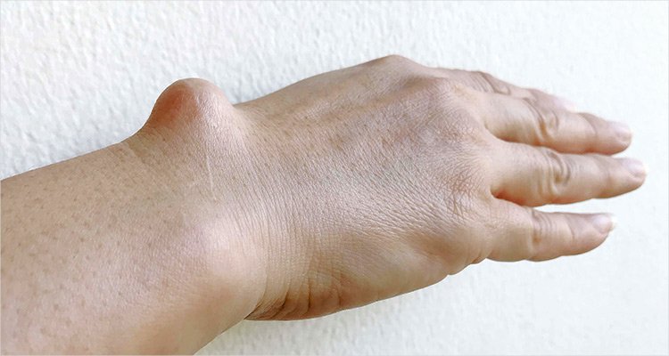 Concept about Osteosarcoma | CHAPTER 15 | Orthopedic Nursing