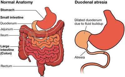 Bowel Intestinal Obstruction | CHAPTER-6 | Medical and Surgical Nursing